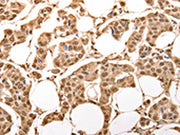 The image on the left is immunohistochemistry of paraffin-embedded Human breast cancer tissue using CSB-PA073168(ACO2 Antibody) at dilution 1/30, on the right is treated with synthetic peptide. (Original magnification: ×200)