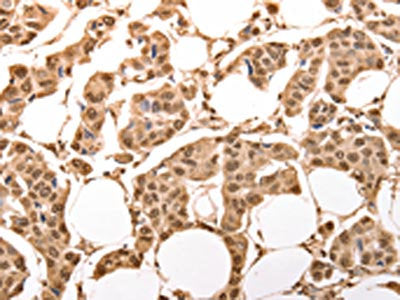 The image on the left is immunohistochemistry of paraffin-embedded Human breast cancer tissue using CSB-PA073168(ACO2 Antibody) at dilution 1/30, on the right is treated with synthetic peptide. (Original magnification: ×200)