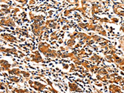 The image on the left is immunohistochemistry of paraffin-embedded Human gastic cancer tissue using CSB-PA073350(ITGAM Antibody) at dilution 1/10, on the right is treated with synthetic peptide. (Original magnification: ×200)