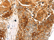 The image on the left is immunohistochemistry of paraffin-embedded Human esophagus cancer tissue using CSB-PA073364(THAP9 Antibody) at dilution 1/20, on the right is treated with synthetic peptide. (Original magnification: ×200)