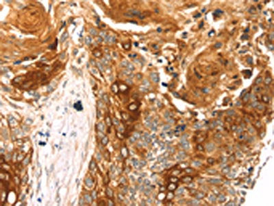 The image on the left is immunohistochemistry of paraffin-embedded Human esophagus cancer tissue using CSB-PA073364(THAP9 Antibody) at dilution 1/20, on the right is treated with synthetic peptide. (Original magnification: ×200)