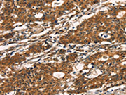 The image on the left is immunohistochemistry of paraffin-embedded Human gastic cancer tissue using CSB-PA073427(KLRC1 Antibody) at dilution 1/20, on the right is treated with fusion protein. (Original magnification: ×200)
