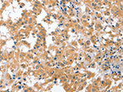 The image on the left is immunohistochemistry of paraffin-embedded Human thyroid cancer tissue using CSB-PA073505(CDR2 Antibody) at dilution 1/60, on the right is treated with fusion protein. (Original magnification: ×200)
