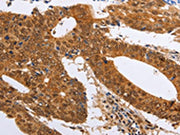 The image on the left is immunohistochemistry of paraffin-embedded Human colon cancer tissue using CSB-PA073605(PSMD8 Antibody) at dilution 1/25, on the right is treated with fusion protein. (Original magnification: ×200)