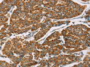 The image on the left is immunohistochemistry of paraffin-embedded Human breast cancer tissue using CSB-PA073786(DLL4 Antibody) at dilution 1/40, on the right is treated with fusion protein. (Original magnification: ×200)