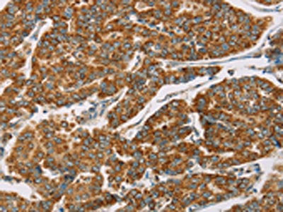 The image on the left is immunohistochemistry of paraffin-embedded Human breast cancer tissue using CSB-PA073786(DLL4 Antibody) at dilution 1/40, on the right is treated with fusion protein. (Original magnification: ×200)