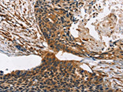 The image on the left is immunohistochemistry of paraffin-embedded Human esophagus cancer tissue using CSB-PA073827(CNGA1 Antibody) at dilution 1/40, on the right is treated with synthetic peptide. (Original magnification: ×200)