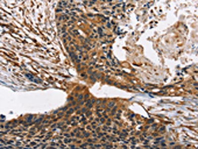 The image on the left is immunohistochemistry of paraffin-embedded Human esophagus cancer tissue using CSB-PA073827(CNGA1 Antibody) at dilution 1/40, on the right is treated with synthetic peptide. (Original magnification: ×200)