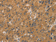 The image on the left is immunohistochemistry of paraffin-embedded Human liver cancer tissue using CSB-PA074176(CYP17A1 Antibody) at dilution 1/20, on the right is treated with fusion protein. (Original magnification: ×200)