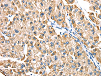 The image on the left is immunohistochemistry of paraffin-embedded Human liver cancer tissue using CSB-PA074212(LTB4R2 Antibody) at dilution 1/20, on the right is treated with synthetic peptide. (Original magnification: ×200)