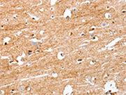 The image on the left is immunohistochemistry of paraffin-embedded Human brain tissue using CSB-PA074357(S100B Antibody) at dilution 1/50, on the right is treated with synthetic peptide. (Original magnification: ×200)