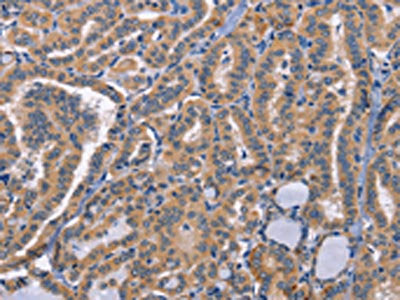 The image on the left is immunohistochemistry of paraffin-embedded Human thyroid cancer tissue using CSB-PA074453(CD48 Antibody) at dilution 1/50, on the right is treated with synthetic peptide. (Original magnification: ×200)