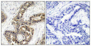 Immunohistochemical analysis of paraffin-embedded human breast carcinoma tissue using p21Cip1(Phospho-Thr145) Antibody(left) or the same antibody preincubated with blocking peptide(right).