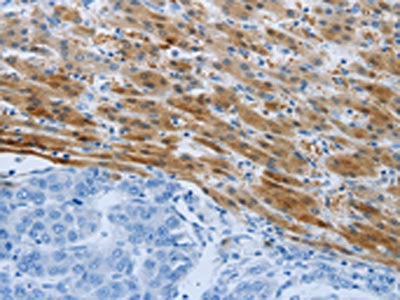 The image on the left is immunohistochemistry of paraffin-embedded Human liver cancer tissue using CSB-PA075089(PSMD11 Antibody) at dilution 1/50, on the right is treated with synthetic peptide. (Original magnification: ×200)