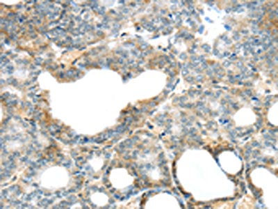 The image on the left is immunohistochemistry of paraffin-embedded Human thyroid cancer tissue using CSB-PA075099(SERPINB11 Antibody) at dilution 1/20, on the right is treated with fusion protein. (Original magnification: ×200)