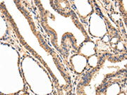 The image on the left is immunohistochemistry of paraffin-embedded Human thyroid cancer tissue using CSB-PA075147(USP5 Antibody) at dilution 1/25, on the right is treated with fusion protein. (Original magnification: ×200)