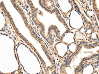 The image on the left is immunohistochemistry of paraffin-embedded Human thyroid cancer tissue using CSB-PA075147(USP5 Antibody) at dilution 1/25, on the right is treated with fusion protein. (Original magnification: ×200)