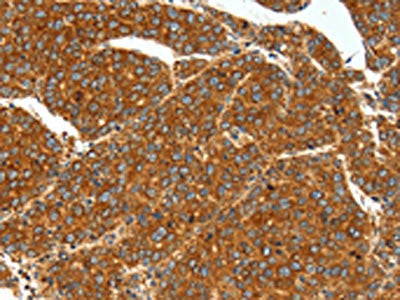 The image on the left is immunohistochemistry of paraffin-embedded Human liver cancer tissue using CSB-PA075436(SSTR1 Antibody) at dilution 1/40, on the right is treated with synthetic peptide. (Original magnification: ×200)