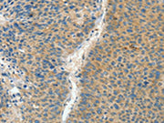 The image on the left is immunohistochemistry of paraffin-embedded Human liver cancer tissue using CSB-PA075666(ASPA Antibody) at dilution 1/60, on the right is treated with fusion protein. (Original magnification: ×200)