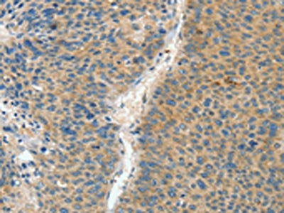 The image on the left is immunohistochemistry of paraffin-embedded Human liver cancer tissue using CSB-PA075666(ASPA Antibody) at dilution 1/60, on the right is treated with fusion protein. (Original magnification: ×200)