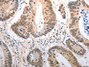 The image on the left is immunohistochemistry of paraffin-embedded Human colon cancer tissue using CSB-PA075718(RAD50 Antibody) at dilution 1/40, on the right is treated with synthetic peptide. (Original magnification: ×200)