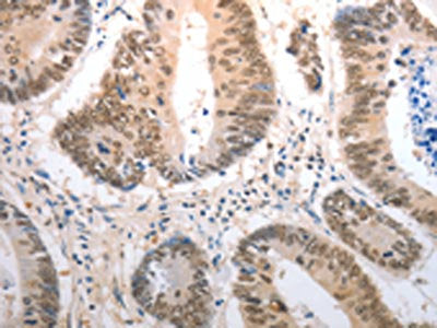 The image on the left is immunohistochemistry of paraffin-embedded Human colon cancer tissue using CSB-PA075718(RAD50 Antibody) at dilution 1/40, on the right is treated with synthetic peptide. (Original magnification: ×200)