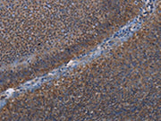 The image on the left is immunohistochemistry of paraffin-embedded Human rectal cancer tissue using CSB-PA075987(LEPREL2 Antibody) at dilution 1/50, on the right is treated with fusion protein. (Original magnification: ×200)