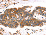 The image on the left is immunohistochemistry of paraffin-embedded Human colon cancer tissue using CSB-PA076189(MLLT4 Antibody) at dilution 1/40, on the right is treated with synthetic peptide. (Original magnification: ×200)