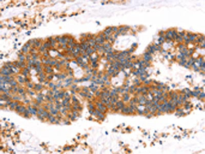 The image on the left is immunohistochemistry of paraffin-embedded Human colon cancer tissue using CSB-PA076189(MLLT4 Antibody) at dilution 1/40, on the right is treated with synthetic peptide. (Original magnification: ×200)