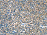 The image on the left is immunohistochemistry of paraffin-embedded Human lymphoma tissue using CSB-PA076734(ATF2 Antibody) at dilution 1/15, on the right is treated with fusion protein. (Original magnification: ×200)
