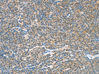 The image on the left is immunohistochemistry of paraffin-embedded Human lymphoma tissue using CSB-PA076734(ATF2 Antibody) at dilution 1/15, on the right is treated with fusion protein. (Original magnification: ×200)
