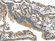 The image on the left is immunohistochemistry of paraffin-embedded Human thyroid cancer tissue using CSB-PA076745(SMYD3 Antibody) at dilution 1/25, on the right is treated with fusion protein. (Original magnification: ×200)