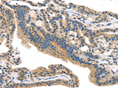 The image on the left is immunohistochemistry of paraffin-embedded Human thyroid cancer tissue using CSB-PA076745(SMYD3 Antibody) at dilution 1/25, on the right is treated with fusion protein. (Original magnification: ×200)