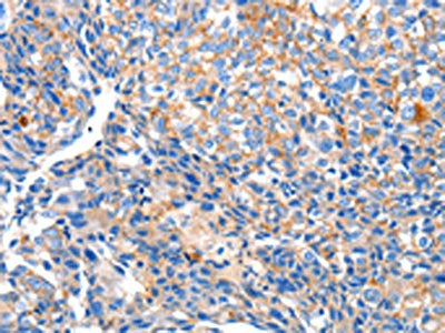 The image on the left is immunohistochemistry of paraffin-embedded Human breast cancer tissue using CSB-PA076798(HCN2 Antibody) at dilution 1/80, on the right is treated with synthetic peptide. (Original magnification: ×200)