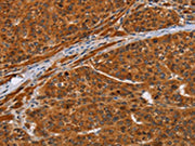The image on the left is immunohistochemistry of paraffin-embedded Human liver cancer tissue using CSB-PA076874(NIF3L1 Antibody) at dilution 1/20, on the right is treated with fusion protein. (Original magnification: ×200)
