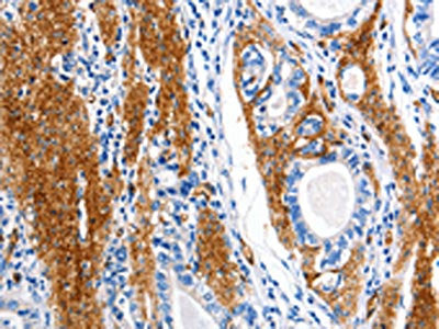 The image on the left is immunohistochemistry of paraffin-embedded Human stomach cancer tissue using CSB-PA076907(AQP1 Antibody) at dilution 1/5, on the right is treated with synthetic peptide. (Original magnification: ×200)