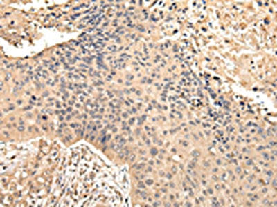 The image on the left is immunohistochemistry of paraffin-embedded Human esophagus cancer tissue using CSB-PA076908(VPS35 Antibody) at dilution 1/45, on the right is treated with fusion protein. (Original magnification: ×200)