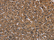 The image on the left is immunohistochemistry of paraffin-embedded Human prostate cancer tissue using CSB-PA077072(HIF1A Antibody) at dilution 1/60, on the right is treated with fusion protein. (Original magnification: ×200)