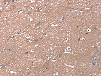 The image on the left is immunohistochemistry of paraffin-embedded Human brain tissue using CSB-PA077173(RHEB Antibody) at dilution 1/20, on the right is treated with fusion protein. (Original magnification: ×200)