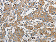 The image on the left is immunohistochemistry of paraffin-embedded Human breast cancer tissue using CSB-PA077190(PRMT5 Antibody) at dilution 1/20, on the right is treated with synthetic peptide. (Original magnification: ×200)