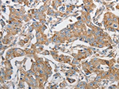 The image on the left is immunohistochemistry of paraffin-embedded Human breast cancer tissue using CSB-PA077190(PRMT5 Antibody) at dilution 1/20, on the right is treated with synthetic peptide. (Original magnification: ×200)