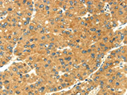 The image on the left is immunohistochemistry of paraffin-embedded Human liver cancer tissue using CSB-PA077271(SEMA4C Antibody) at dilution 1/20, on the right is treated with fusion protein. (Original magnification: ×200)
