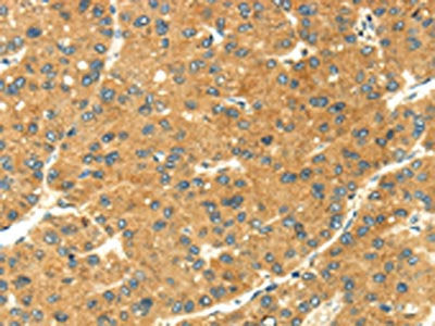 The image on the left is immunohistochemistry of paraffin-embedded Human liver cancer tissue using CSB-PA077271(SEMA4C Antibody) at dilution 1/20, on the right is treated with fusion protein. (Original magnification: ×200)