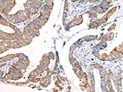The image on the left is immunohistochemistry of paraffin-embedded Human esophagus cancer tissue using CSB-PA077362(KRT7 Antibody) at dilution 1/20, on the right is treated with synthetic peptide. (Original magnification: ×200)