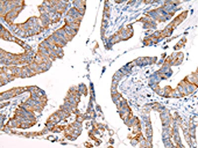 The image on the left is immunohistochemistry of paraffin-embedded Human esophagus cancer tissue using CSB-PA077362(KRT7 Antibody) at dilution 1/20, on the right is treated with synthetic peptide. (Original magnification: ×200)