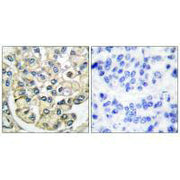 Immunohistochemical analysis of paraffin-embedded human breast carcinoma tissue using FGFR2 antibody.