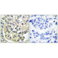 Immunohistochemical analysis of paraffin-embedded human breast carcinoma tissue using FGFR2 antibody.