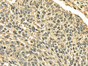 The image on the left is immunohistochemistry of paraffin-embedded Human lung cancer tissue using CSB-PA077536(PLIN3 Antibody) at dilution 1/35, on the right is treated with fusion protein. (Original magnification: ×200)