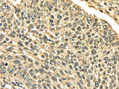 The image on the left is immunohistochemistry of paraffin-embedded Human lung cancer tissue using CSB-PA077536(PLIN3 Antibody) at dilution 1/35, on the right is treated with fusion protein. (Original magnification: ×200)