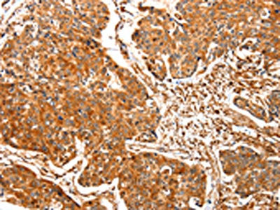The image on the left is immunohistochemistry of paraffin-embedded Human esophagus cancer tissue using CSB-PA077768(TPM2 Antibody) at dilution 1/30, on the right is treated with synthetic peptide. (Original magnification: ×200)